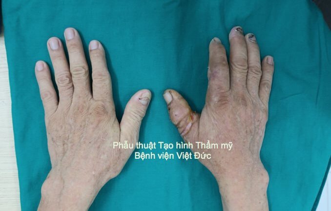 Nối thành công ngón tay cái đứt rời cho người đàn ông 67 tuổi