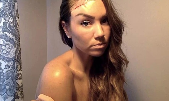 Cô gái bị ung thư do nghiện nhuộm nâu da