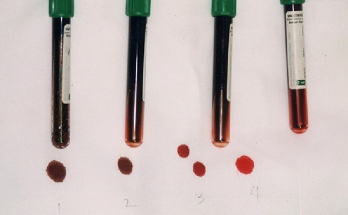 Bí ẩn dòng họ duy nhất thế giới có làn da màu xanh da trời