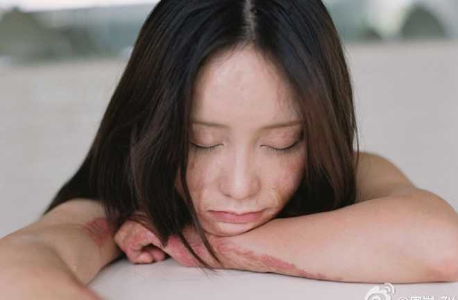 Người mẫu teen từng bị thiêu sống vì tình lộ diện sau 5 năm