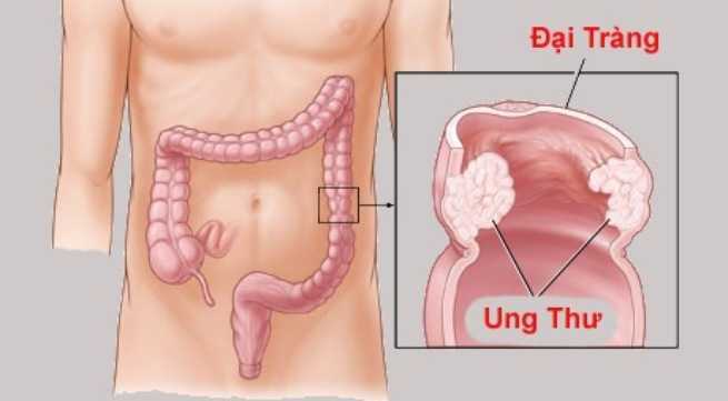 Nếu chẳng may mắc ung thư đại trực tràng, làm thế nào để sống khỏe tới già?