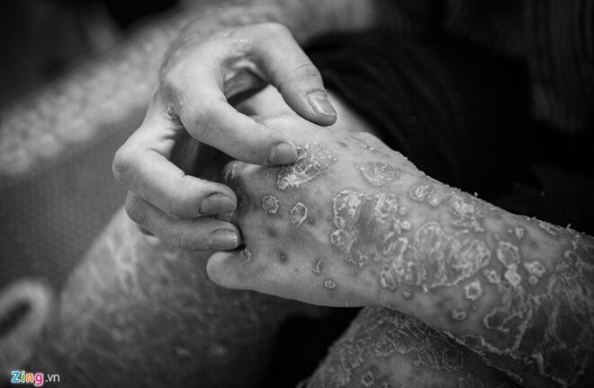 Trầm cảm, tự tử vì không chịu được áp lực khi mắc bệnh vảy nến