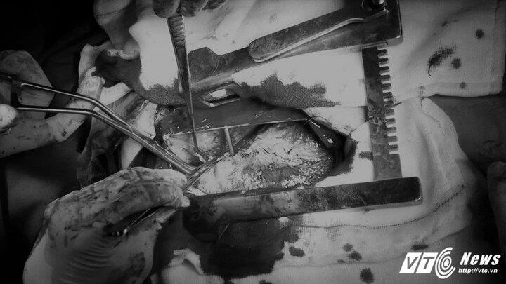 Bệnh viện quận cứu sống bệnh nhân vỡ tim do tai nạn giao thông