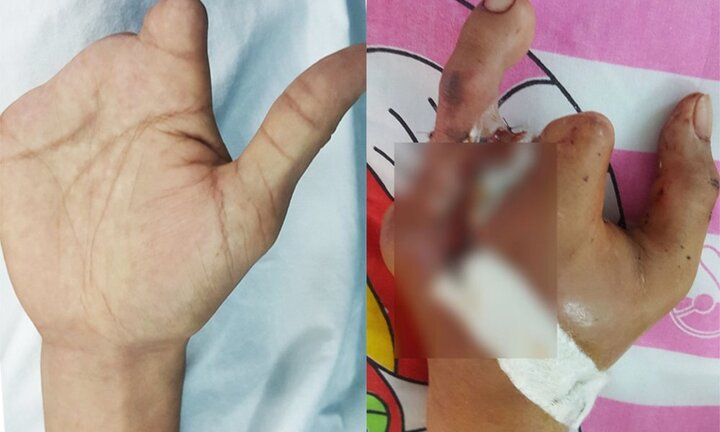 Nam thanh niên cắt ngón chân ghép vào bàn tay bị cụt