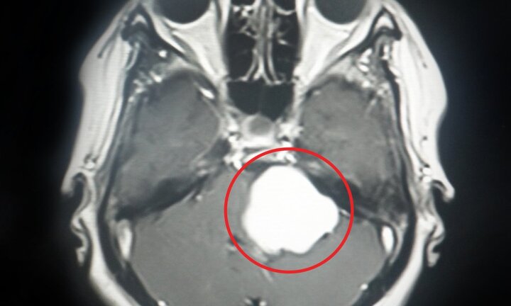 Hi hữu: Tách thành công khối u màng não to bằng quả bóng bàn ra khỏi đầu bệnh nhân