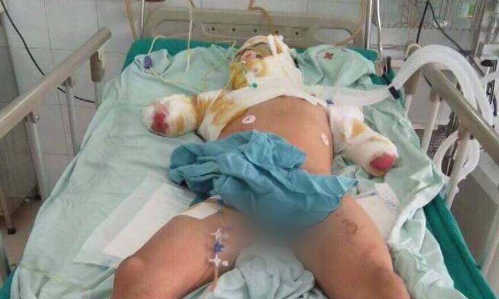 Gia cảnh khốn khó của nam thanh niên phải cắt bỏ 2 cánh tay khi giúp hàng xóm sửa điện