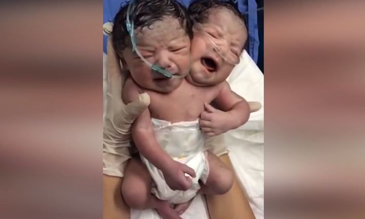 Em bé chào đời có 2 đầu