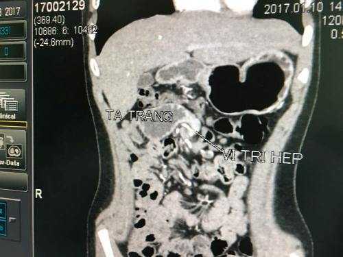 Đau bụng dữ dội, bé trai 12 tuổi nhập viện vì bệnh lạ hiếm gặp