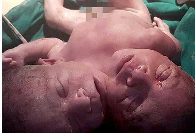 Em bé có 2 đầu tử vong sau vài giờ chào đời