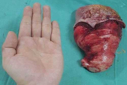 Cụ bà có chiếc lưỡi lớn nhất Việt Nam được phẫu thuật cắt bỏ thành công