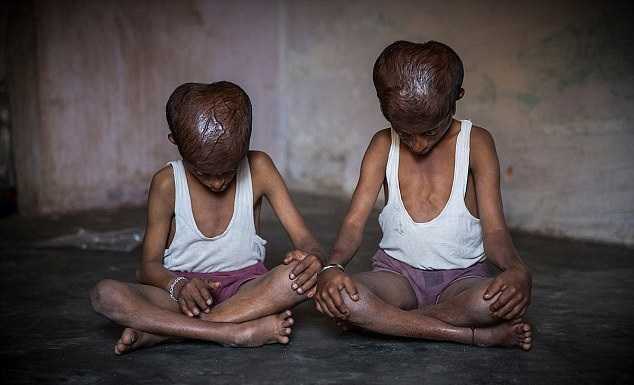 Y học bó tay với hai cậu bé trông già như ông lão 80