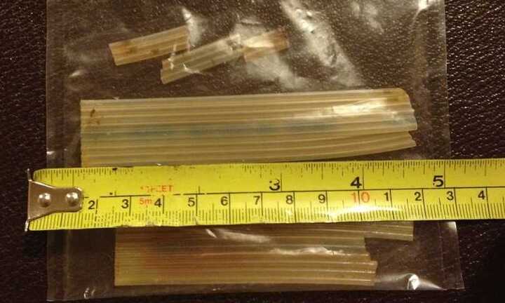 Bệnh viện bị kiện vì để quên ống nhựa hơn 20 năm trong bụng bệnh nhân