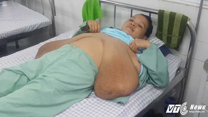 Tìm ra phương pháp cứu cô gái có bộ ngực ‘khủng’ chảy dài xuống đùi