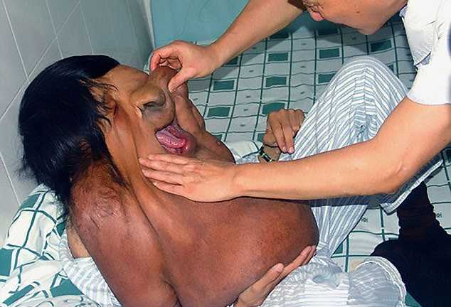 Người đàn ông mắc bệnh lạ khiến khuôn mặt chảy xệ đến bụng bị gọi là 'quái vật'