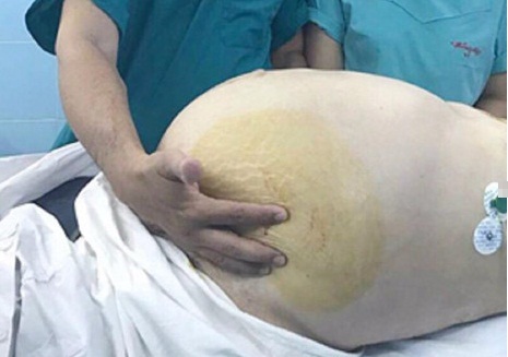 Cụ bà 74 tuổi được phẫu thuật loại bỏ khối u nặng 20kg trong ổ bụng