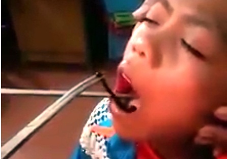 Kinh hãi gắp con vắt sống trong họng bệnh nhân suốt 2 tháng