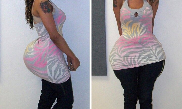 Nâng mông bằng keo vá lốp và xi măng, một người tử vong