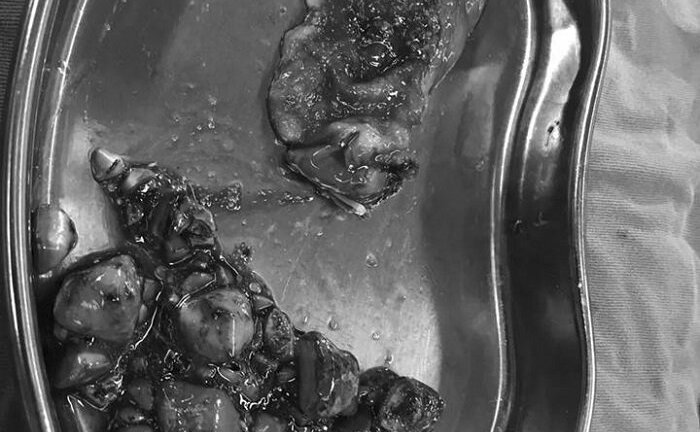 Ăn nhiều mỳ tôm và đồ ăn sẵn, cô gái bị kết 100 viên sỏi trong túi mật