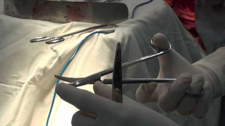 Người đàn ông sống 18 năm với cây kéo để quên trong bụng