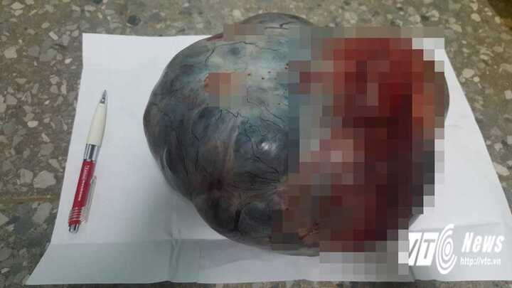 Kinh hãi khối u 'khủng' hơn 4 kg trong bụng cụ bà 85 tuổi