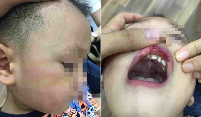 Cô giáo mầm non ở Hà Nội tát trẻ bầm dập, tụ máu môi