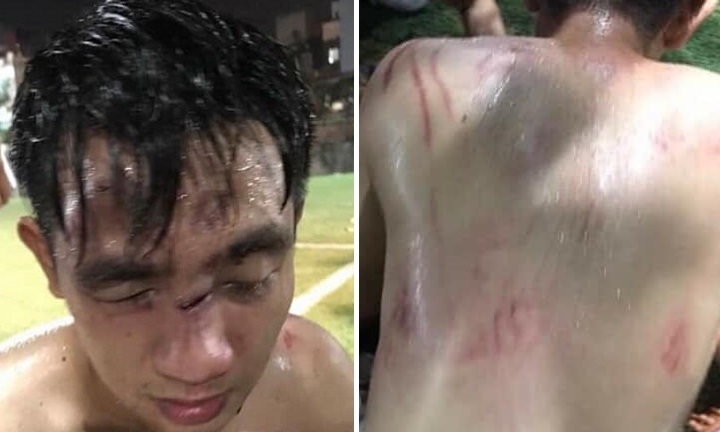 Va chạm khi tranh chấp bóng, nam thanh niên bị đội bạn đánh nhập viện ở Hà Nội