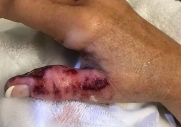 Người phụ nữ suýt mất tay do 'vi khuẩn ăn thịt người'