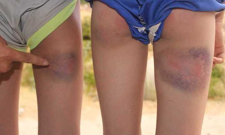 Làm gãy ghế, 6 học sinh bị thầy giáo đánh tím đùi