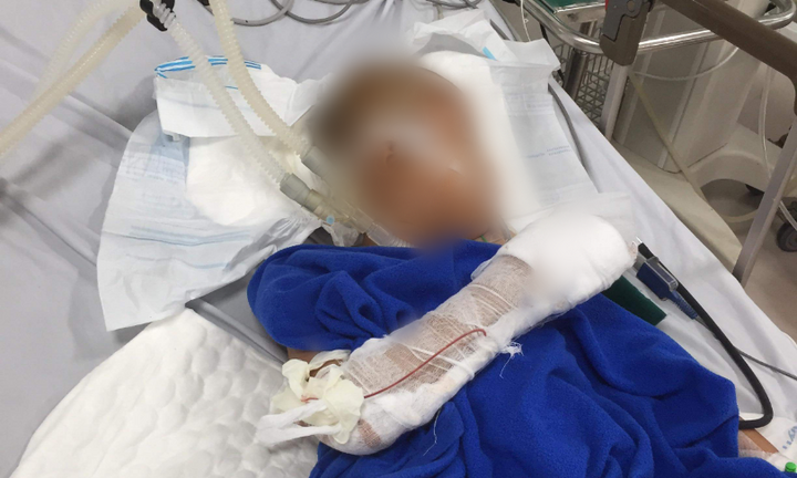Bé trai 9 tuổi bị nam thanh niên chém lún hộp sọ