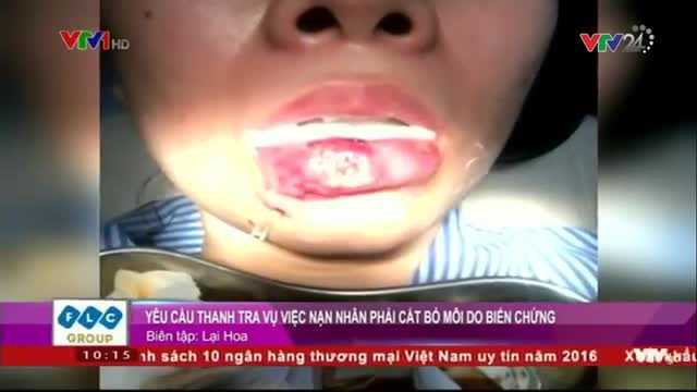 Bị hoại tử, phải cắt bỏ môi sau khi bơm chất làm mọng