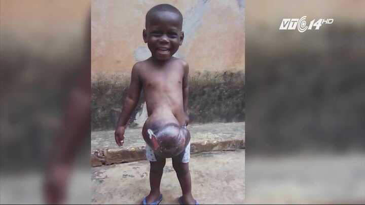 Bé 3 tuổi có nội tạng nằm ngoài cơ thể