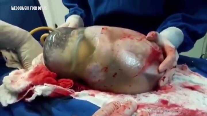 Kỳ diệu khoảnh khắc em bé chào đời trong bọc nước ối còn nguyên