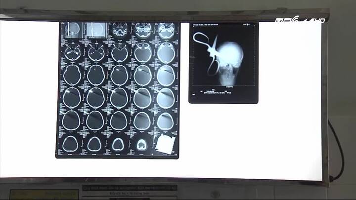 Đồng Nai: Bé trai 13 tuổi bị bố ném kéo xuyên sọ não