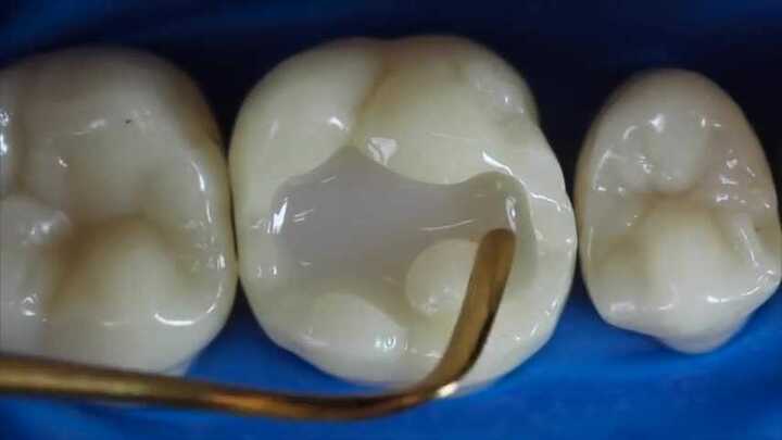 Tròn mắt xem quá trình hàn một chiếc răng sâu