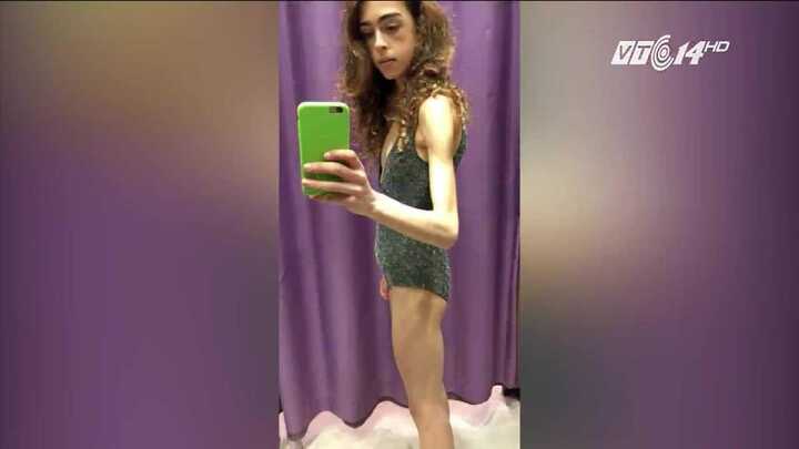 Bị chê đùi to, cô gái điên cuồng giảm chỉ còn 25kg