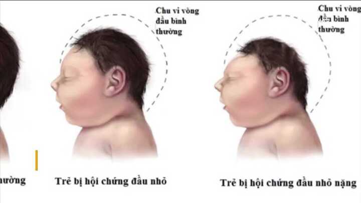 Việt Nam xuất hiện em bé đầu nhỏ đầu tiên nghi do Zika
