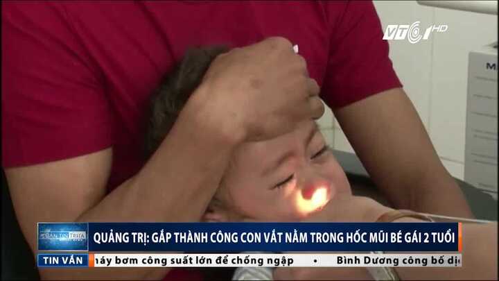 Gắp thành công con vắt dài 2,5cm trong hốc mũi bé 2 tuổi
