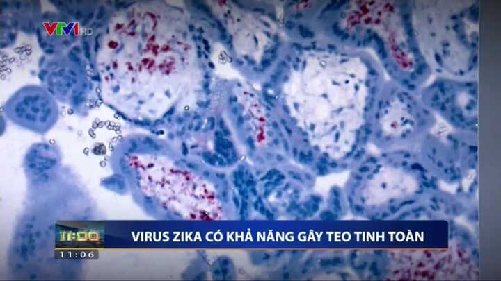 Phát hiện mới: Virus Zika có thể gây teo tinh hoàn ở nam giới