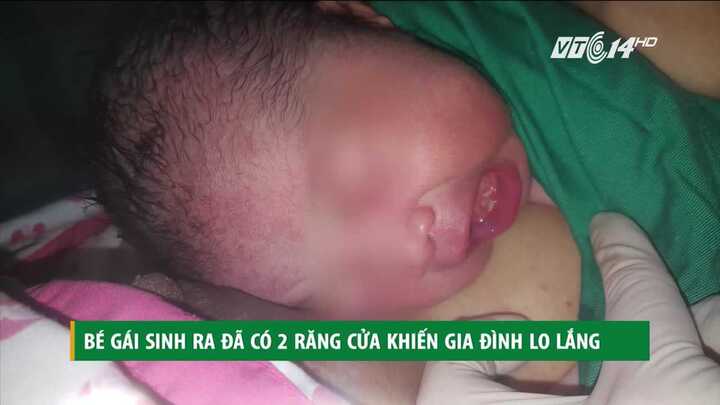 Kỳ lạ bé gái vừa sinh ra đã có 2 răng cửa ở TP.HCM