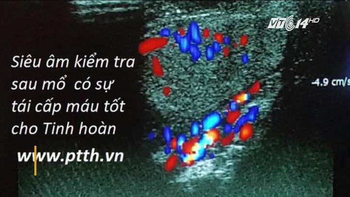 Video: Phẫu thuật cho thanh niên tự cắt lìa dương vật và tinh hoàn