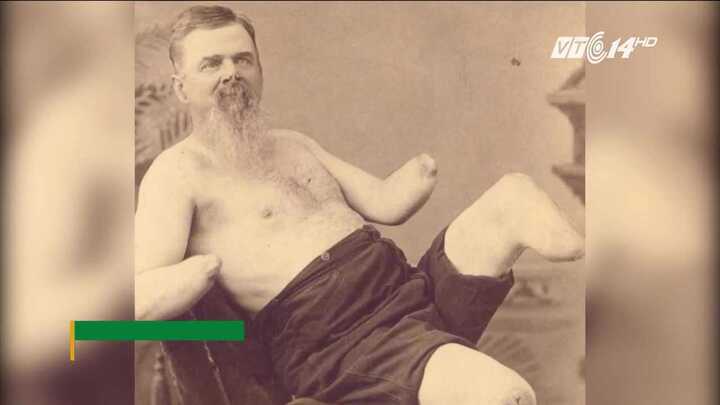 Vì sao nhiều người thích tự cắt bộ phận cơ thể?