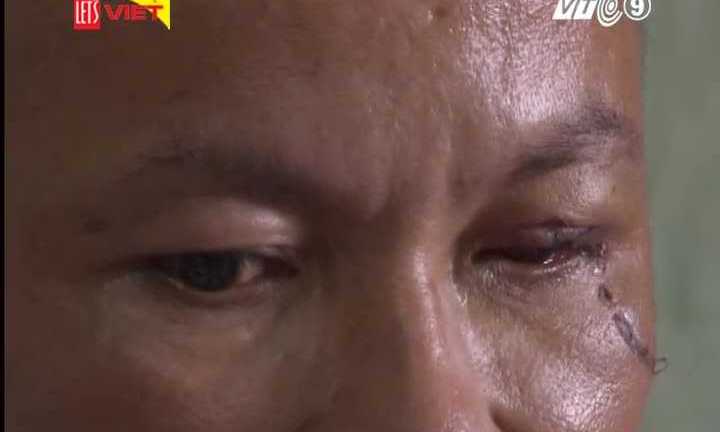 Sơ cứu đúng cách khi bị chấn thương mắt do hóa chất, vật nhọn đâm