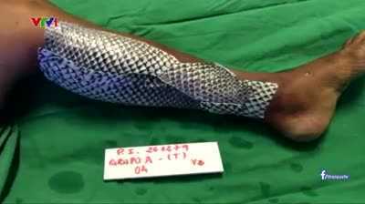 Video: Mục sở thị phương pháp trị bỏng bằng da cá rô phi