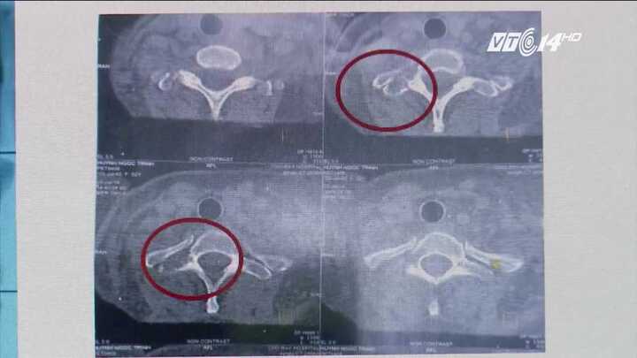 Bệnh hiếm khiến người mắc bị giảm chiều cao từ 1m62 xuống 1m55