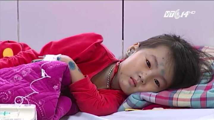 Tiêm phòng thủy đậu vẫn bị bệnh là do nguyên nhân này