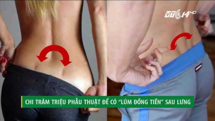 Đua nhau chi hàng trăm triệu phẫu thuật tạo 'lúm đồng tiền' ở... thắt lưng