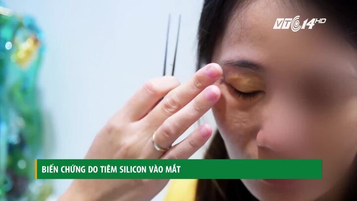 Biến chứng đáng sợ do tiêm silicon làm đẹp vùng mắt