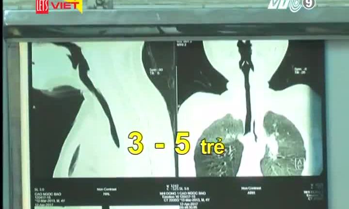 Bé 4 tuổi hóc lõi kèn nhựa, ho ra tiếng kèn