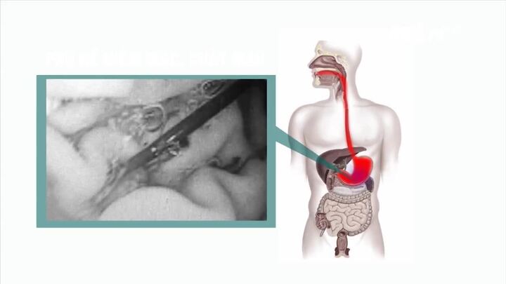 TP.HCM: Nuốt thanh sắt để trốn trại, học viên cai nghiện thủng dạ dày