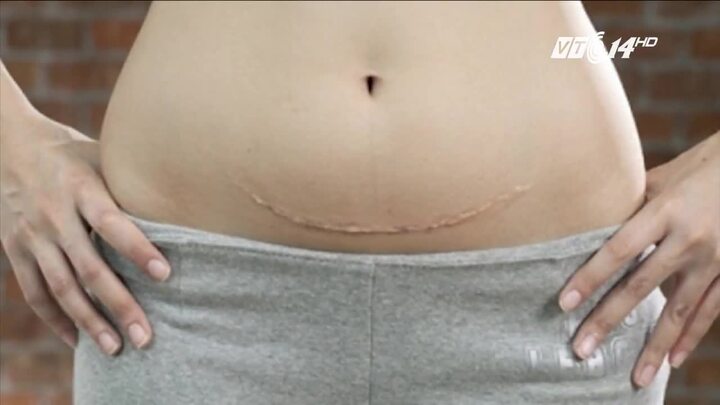 Chửa trên vết mổ: Bệnh lý nguy hiểm có thể cướp đi sinh mạng của bà bầu bất cứ lúc nào